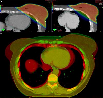 Radiotherapy-Induced Cardiotoxicity: The Role of Multimodality Cardiovascular Imaging